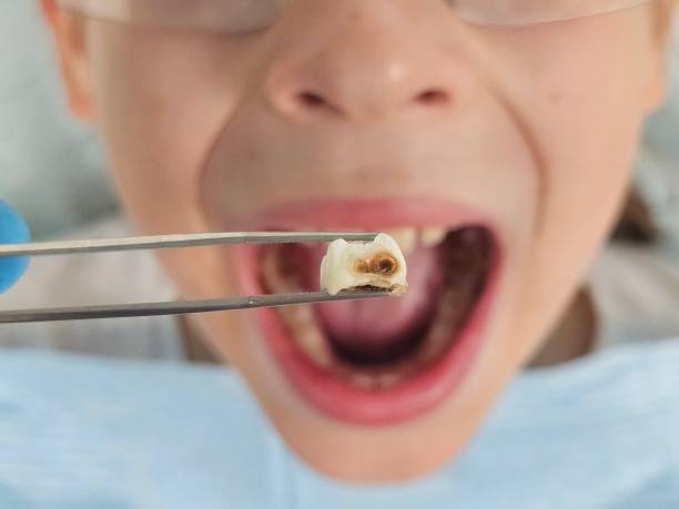 Best Broken or Cracked Tooth Emergency Dentist in Niagara University, NY